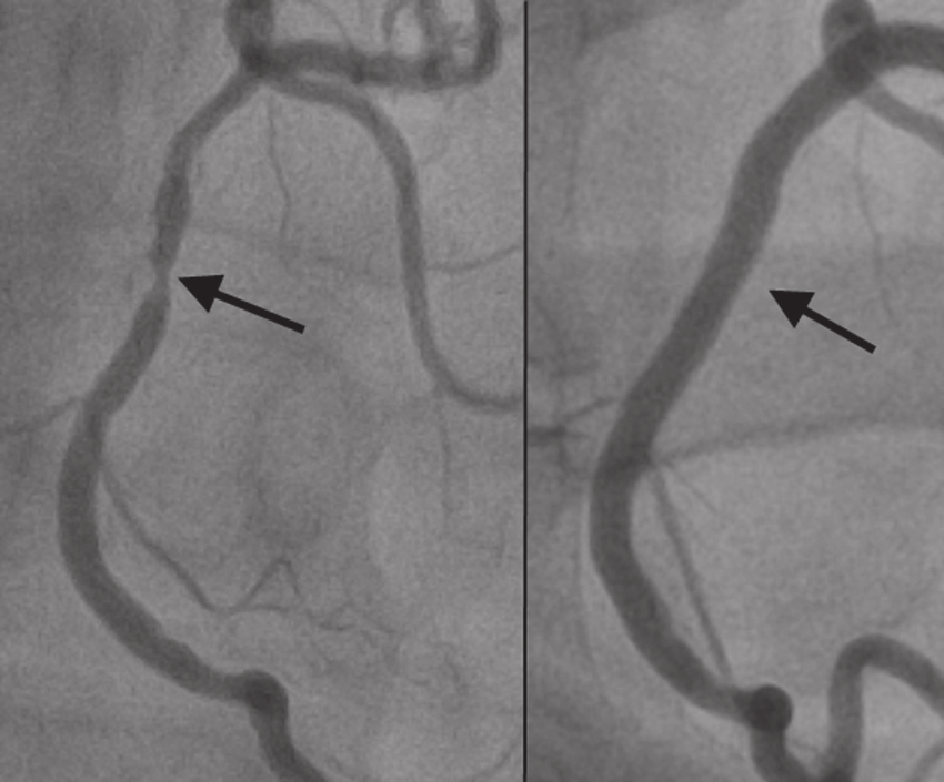 Angioplasty after