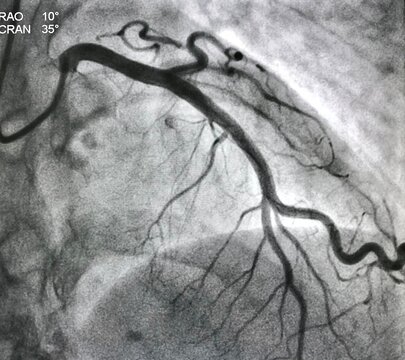 Angiogram at CardioVerse