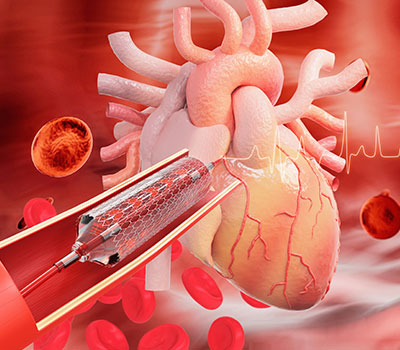 Angioplasty & Stenting